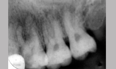 Dentures treatment in Anand
                            