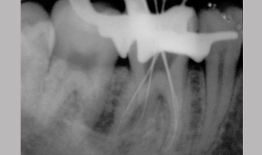 Root canal treatment in Anand                    