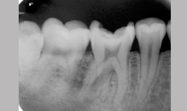 Dental jewellery treatment in Anand                    