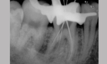 Preventative dentistry treatment in Anand                    